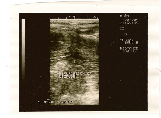 The bifurcation of the uterus. This is where the uterus is “Y” shaped and branches off into the left and right horns, from the single uterine body.