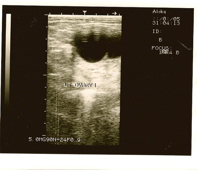 The left ovary, as seen with ultrasound imaging.