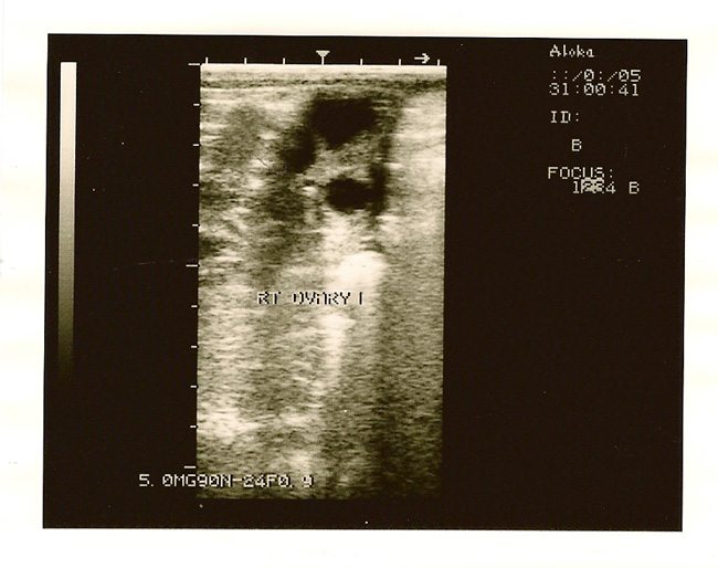The right ovary, as seen with ultrasound imaging.